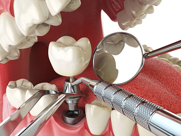 Best Emergency Root Canal Treatment in Tacoma, WA
